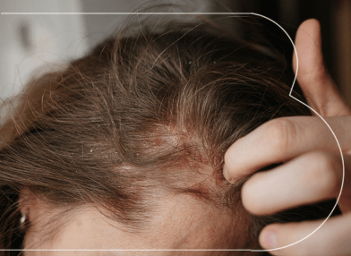Dermatite séborrhéique et pellicules grasses : Comment en venir à bout ?